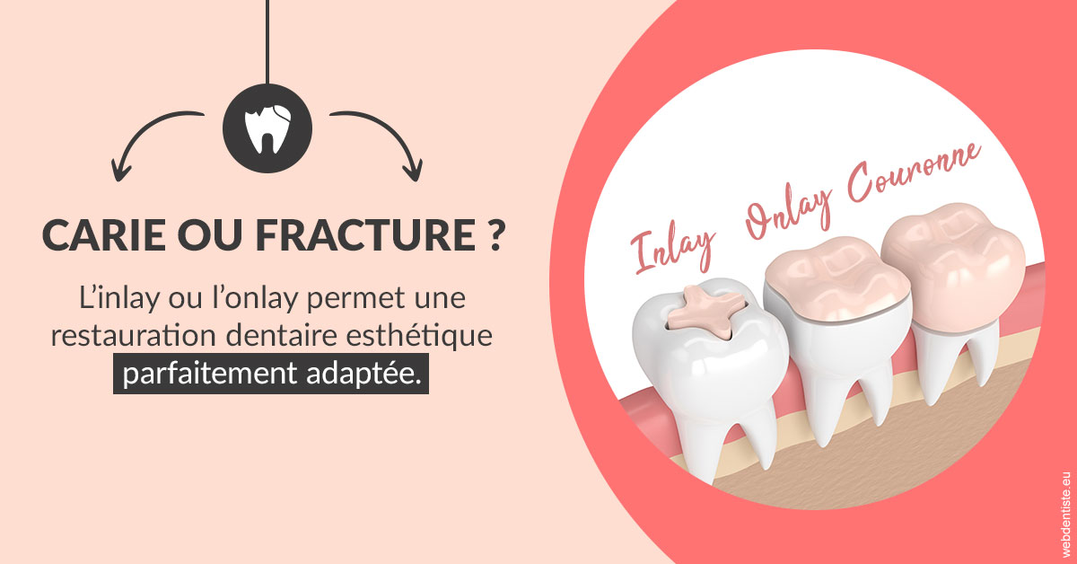https://dr-perotti-laurent.chirurgiens-dentistes.fr/T2 2023 - Carie ou fracture 2