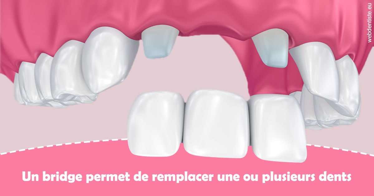 https://dr-perotti-laurent.chirurgiens-dentistes.fr/Bridge remplacer dents 2
