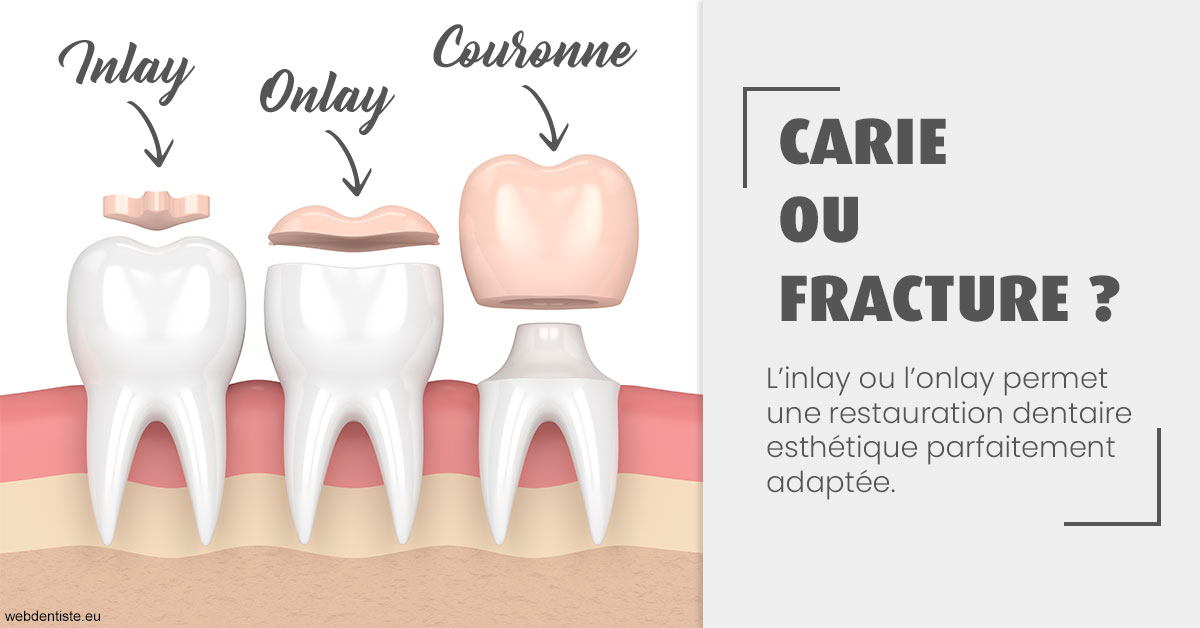 https://dr-perotti-laurent.chirurgiens-dentistes.fr/T2 2023 - Carie ou fracture 1