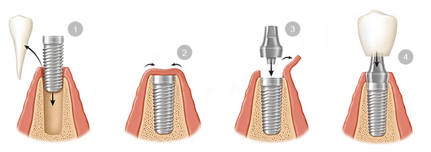 implant-dentaire-marseille