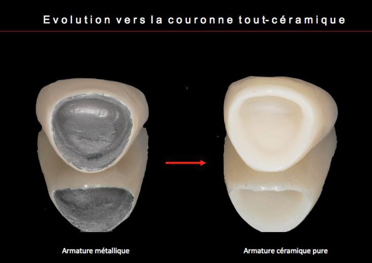 Couronne-dentaire-Metallique-et-Ceramique-pure
