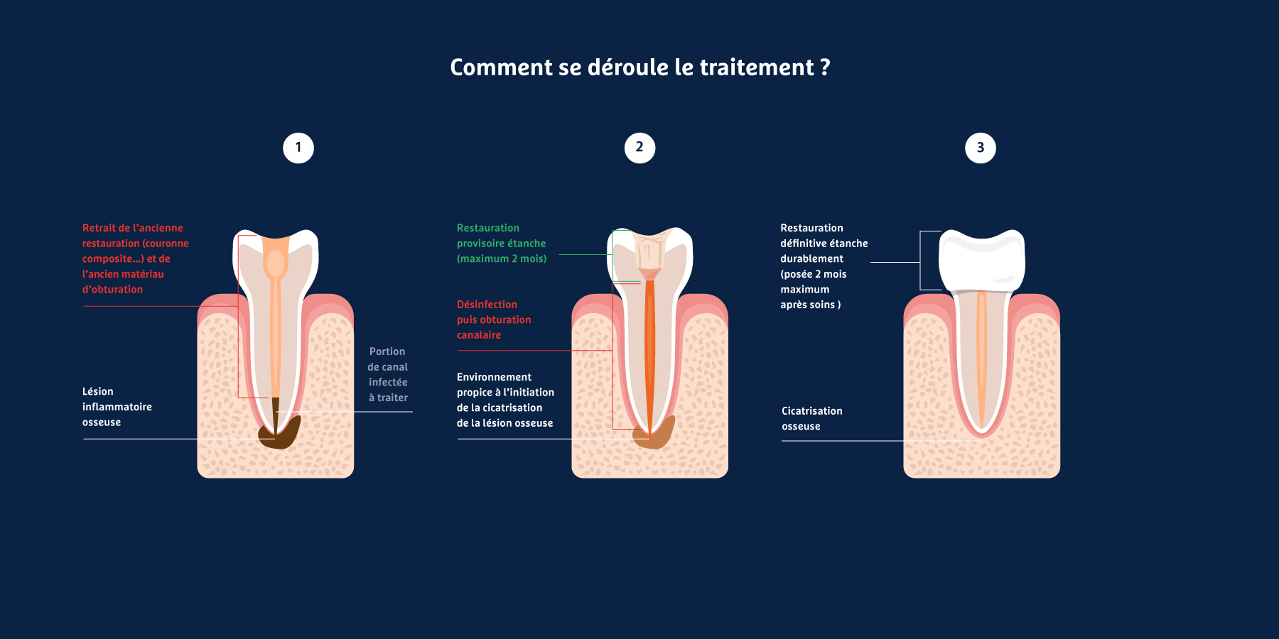 endodontie-deroulement-traitement-endodontie