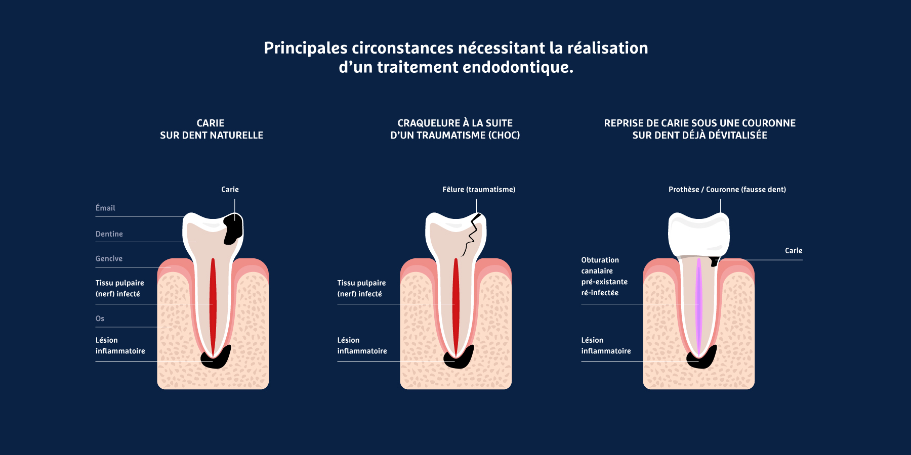 endodontie-causes-traitement-endodontie-web