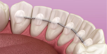 la-contention-orthodontique